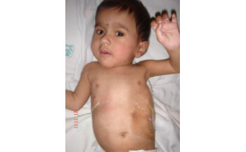 Hydronephrosis in children India